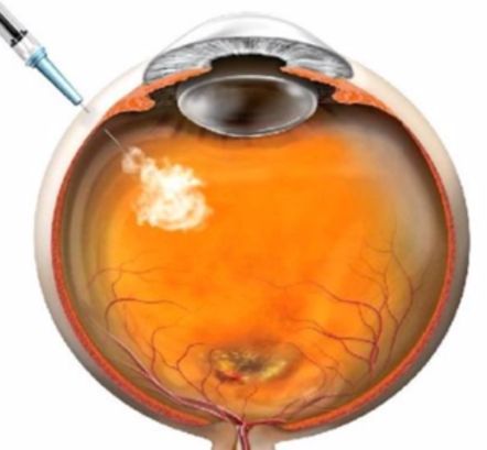 Intraocular Erythropoietin