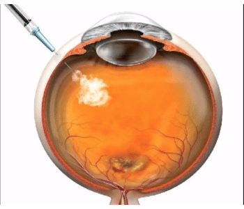Intraocular Erythropoietin