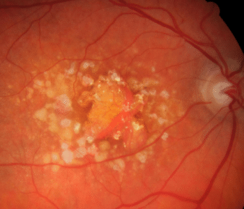 Retinal Image Analysis