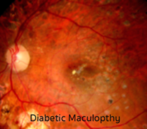 clickable to navigate to diabetic maculopathy
